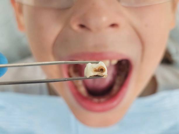 Best Emergency Tooth Extraction in Weleetka, OK